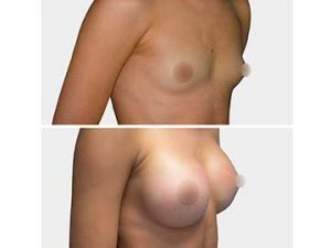 aumento de mamas