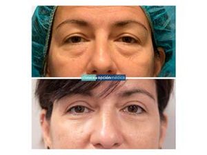 blefaroplastia en mujeres antes y después
